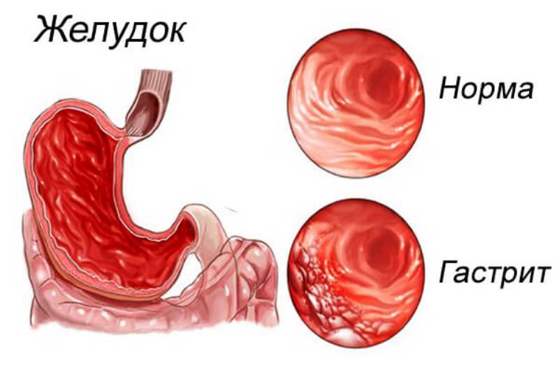 Кишечные заболевания